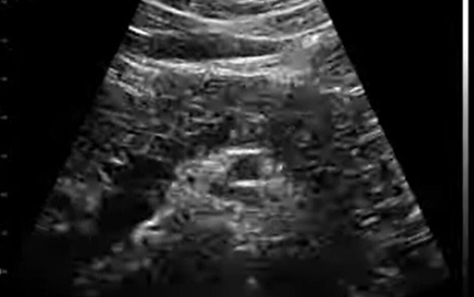 Full Body Ultrasound Pancreas B