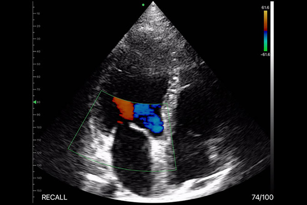 handheld ultrasound device price