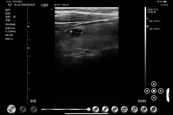 handheld ultrasound device