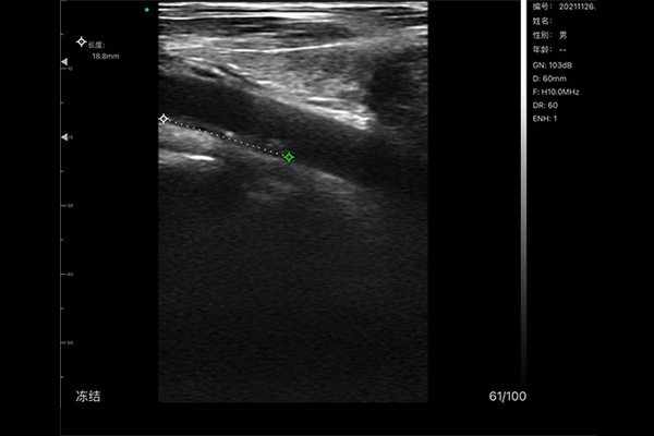 handheld ultrasound machine