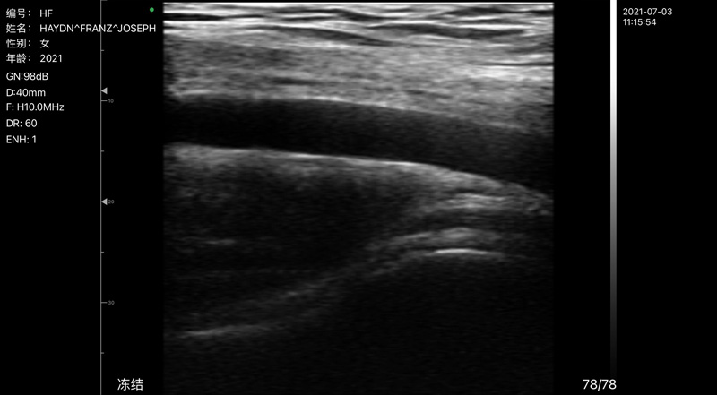 Wireless Ultrasound for Axillary Artery C