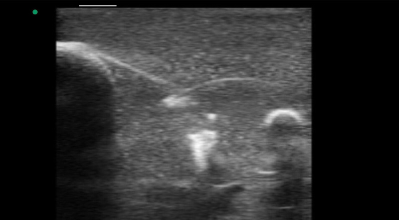 Wireless Ultrasound for Breast Biopsy Training