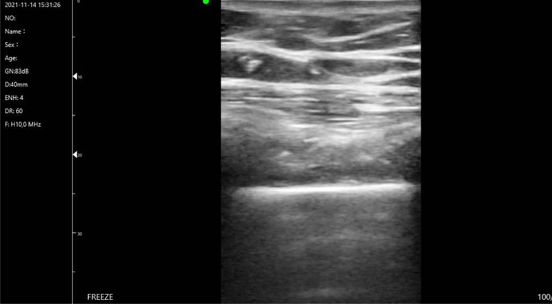 Wireless Ultrasound for C10T Lung