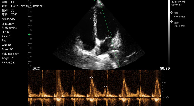 Wireless Ultrasound for Cardiac PW