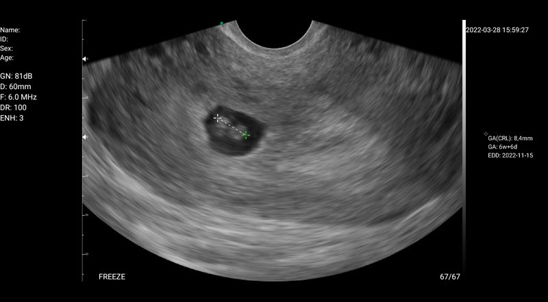 Wireless Ultrasound for Early OB