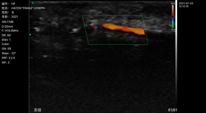 Wireless Ultrasound for Finger Artery