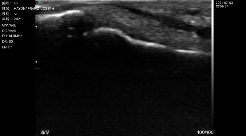 Wireless Ultrasound for Finger Flexor Tendon