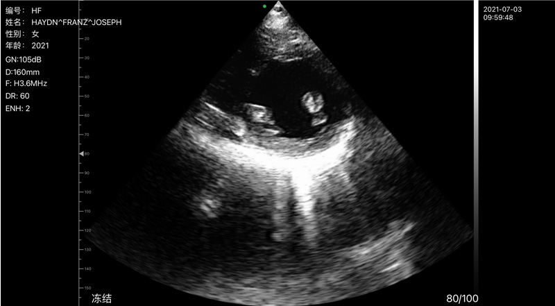 Wireless Ultrasound for Heart Papillary Muscle