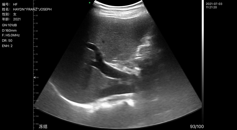 Wireless Ultrasound for Liver B