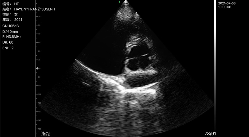 Wireless Ultrasound for Mitral Valve