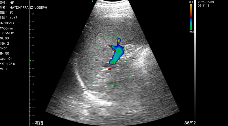 Wireless Ultrasound for Spleen