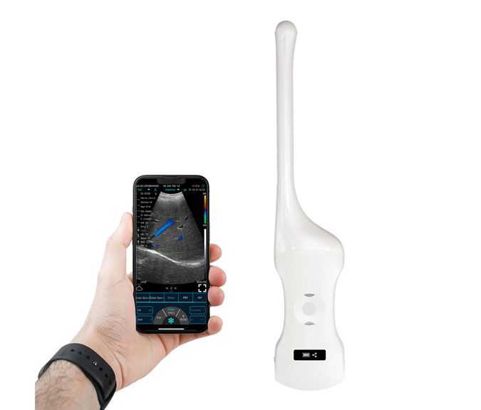 wireless ultrasound transducer