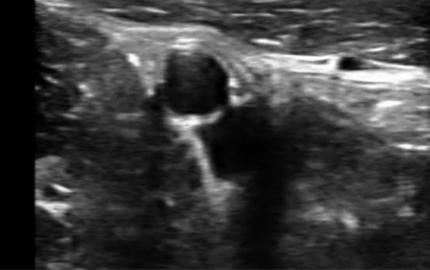 Abdominal Ultrasound Transducer Iliac Artery B