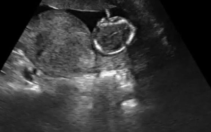 Abdominal Probe Fetal B
