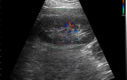 Abdominal Probe Ultrasound kidney C