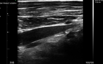 Abdominal Ultrasound Probe Liver B