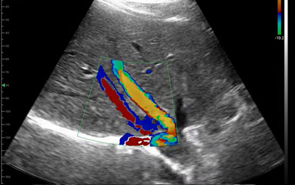 Convex Array Transducer Liver C