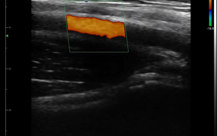 Linear Array Probe Ultrasound Axillary Artery C
