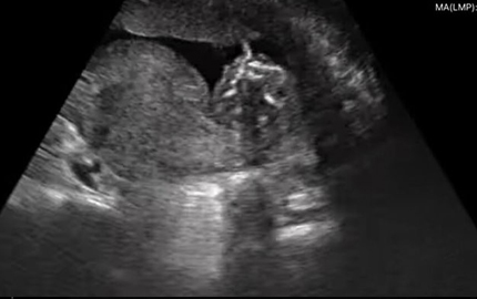 Whole Body Abdomen Ultrasound Fetal B
