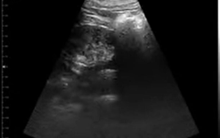 Whole Body Ultrasound Kidney B