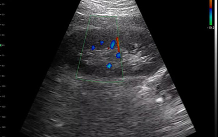 Whole Body Ultrasound Scan Kidney C