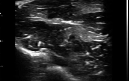 Curved Linear Probe Median Nerve