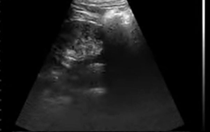 Hand Held Ultrasound Kidney