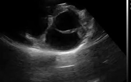 Whole Abdomen Scan Cost B Gallbladder