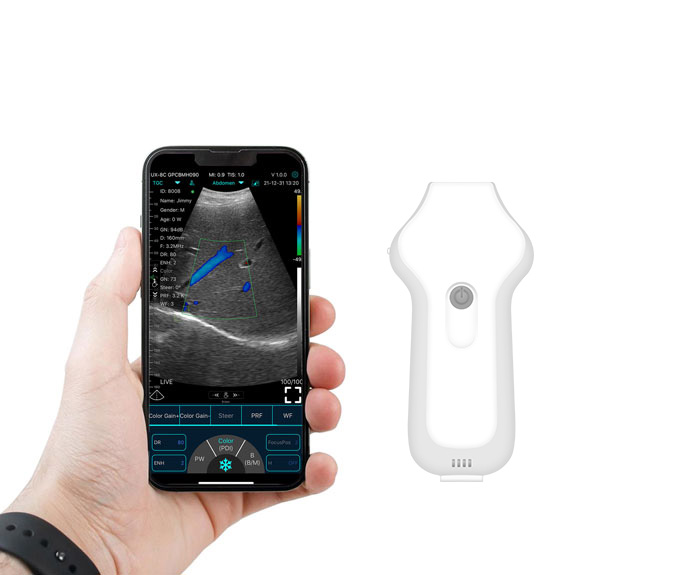 wireless cardiac ultrasound