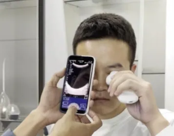 Wireless Ultrasound Probe Used in Ophthalmology